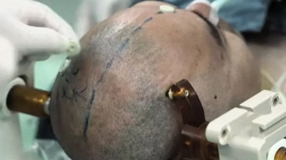 Chiny dogoniły Elona Muska. Testują już na ludziach własny Neuralink